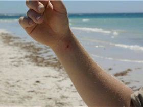 Mega pain after a Stingray barb in the wrist