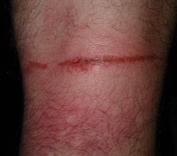 back of knee after getting dragged underwater by kiteline