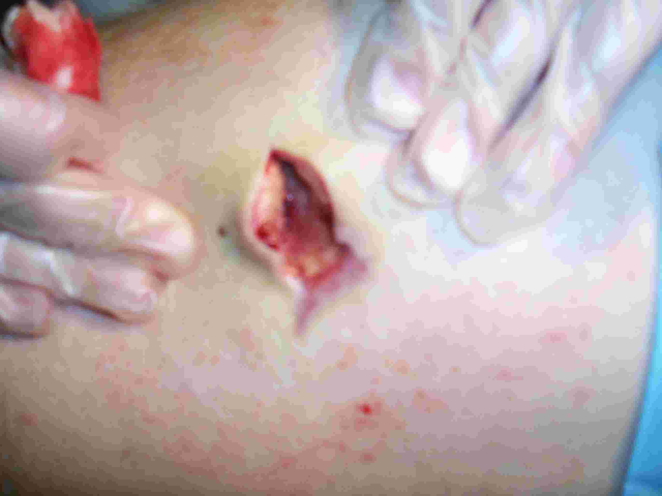 Stingray wound after 5 weeks