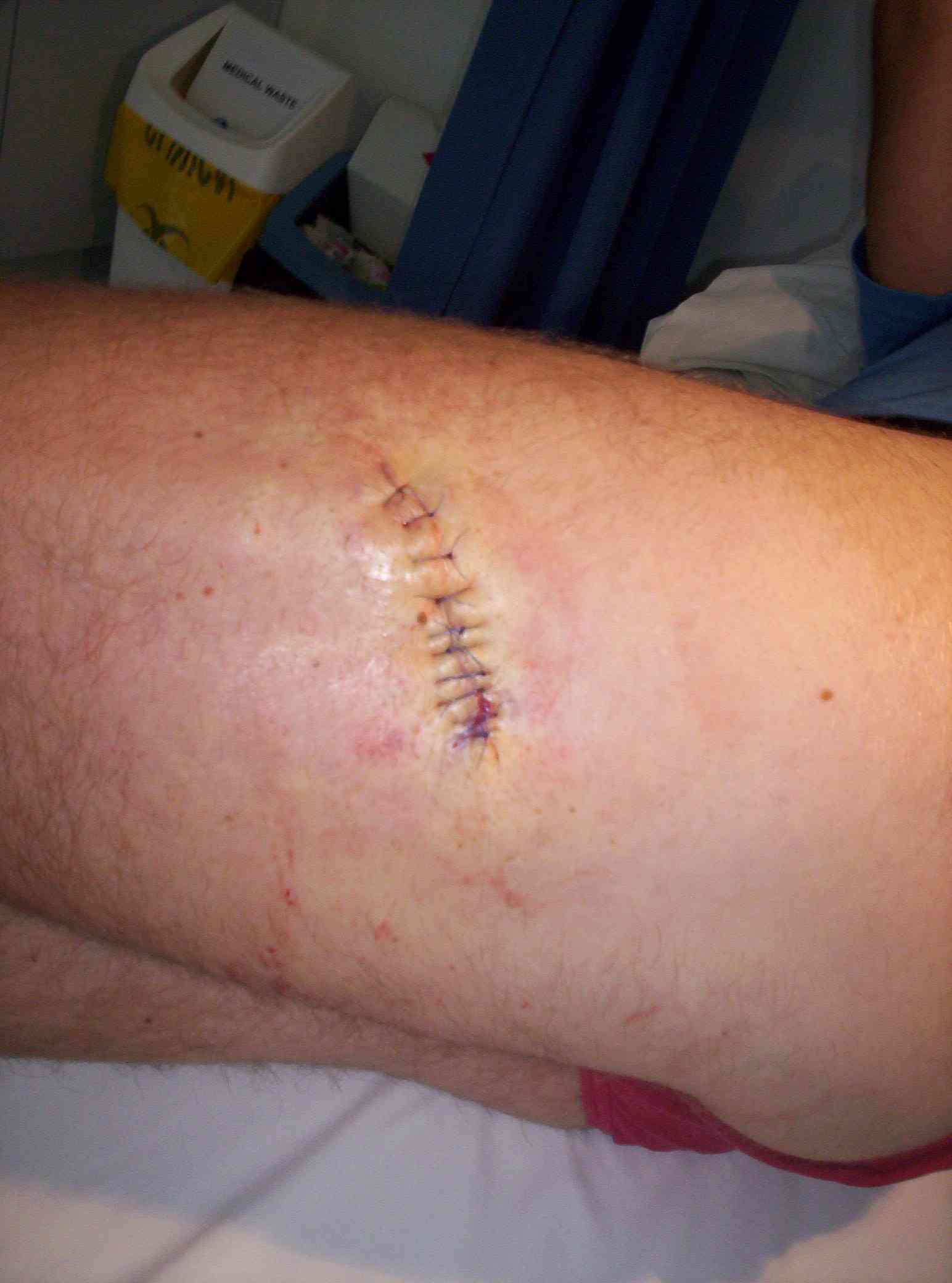 Stingray hole after 7 weeks