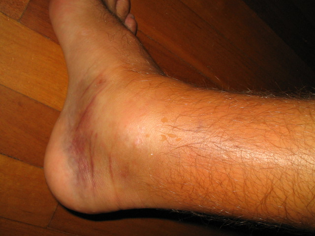 fat ankle..post kiteloop