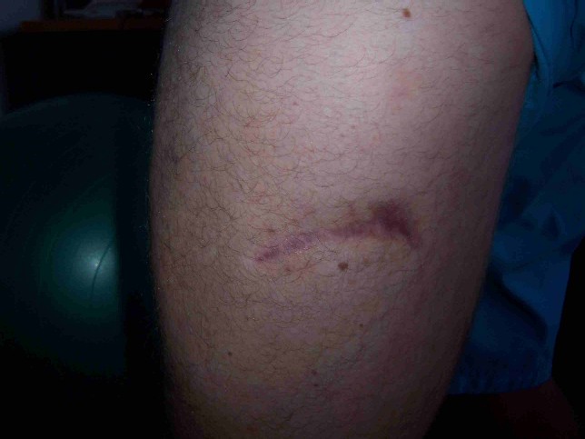 Stingray Scar 11 months later