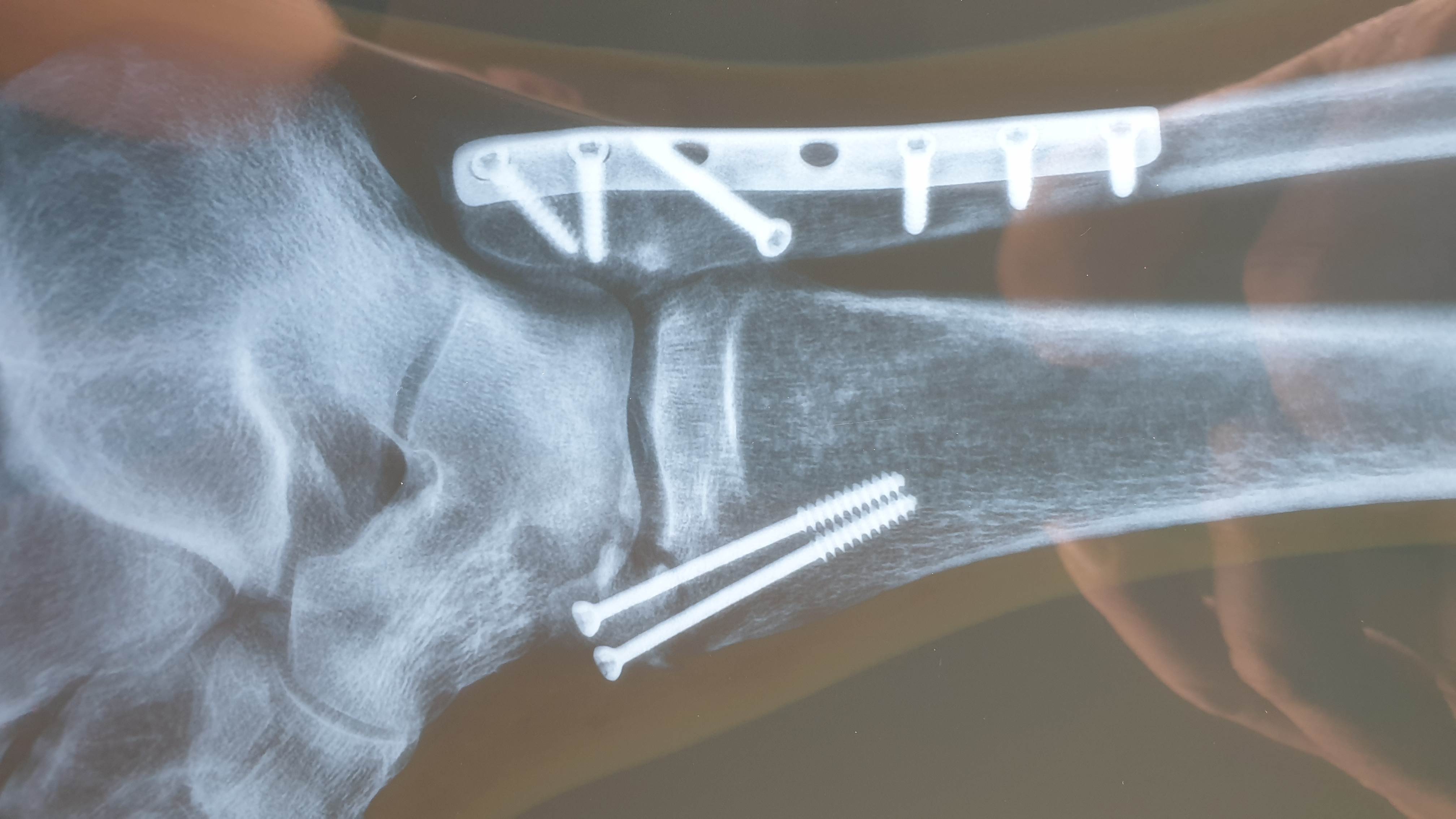 One foot out of foot strap