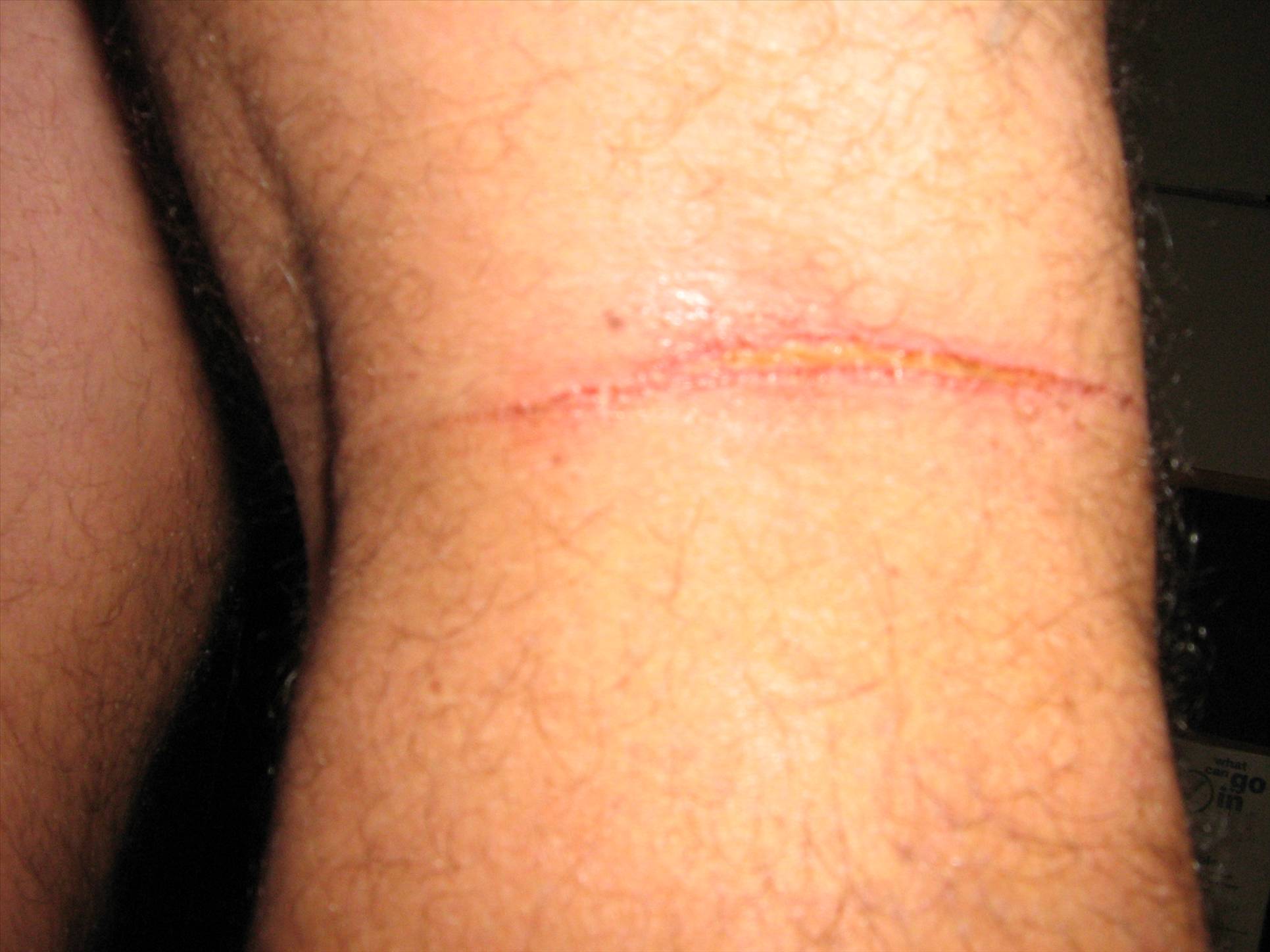 Legs vs lines!!  Not cool!!