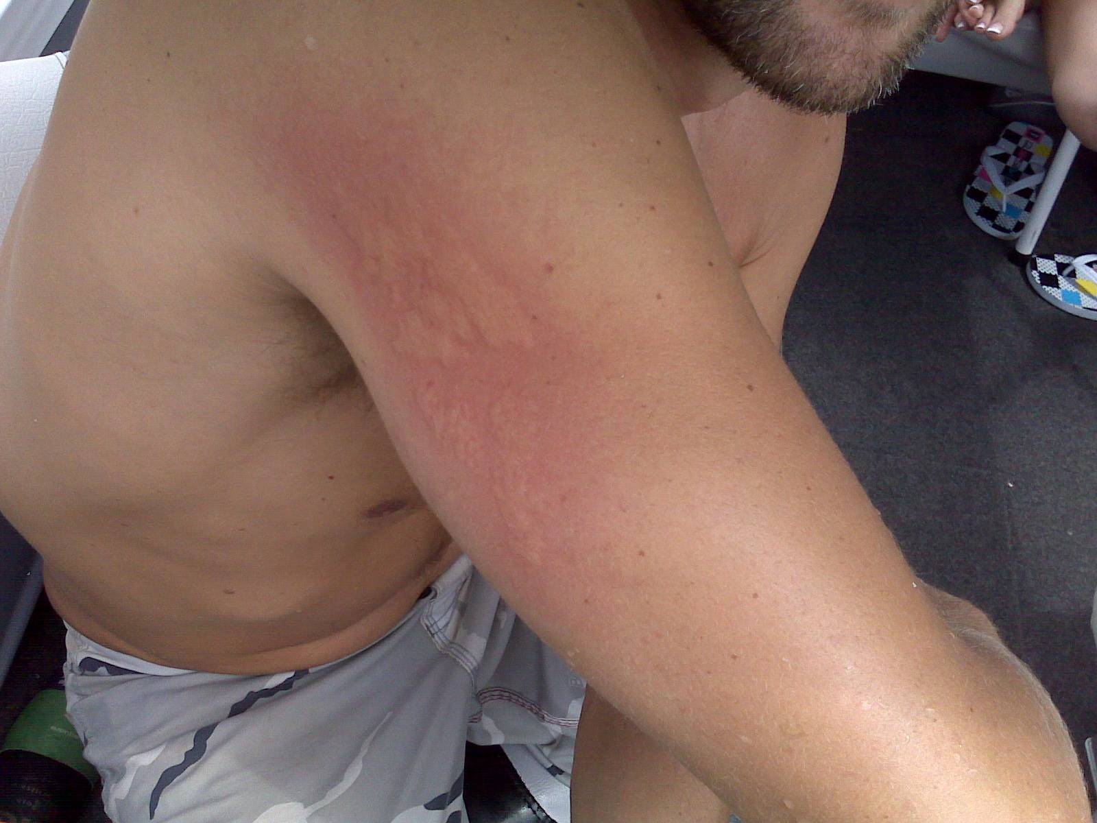 Blue Blubber Jellyfish Sting