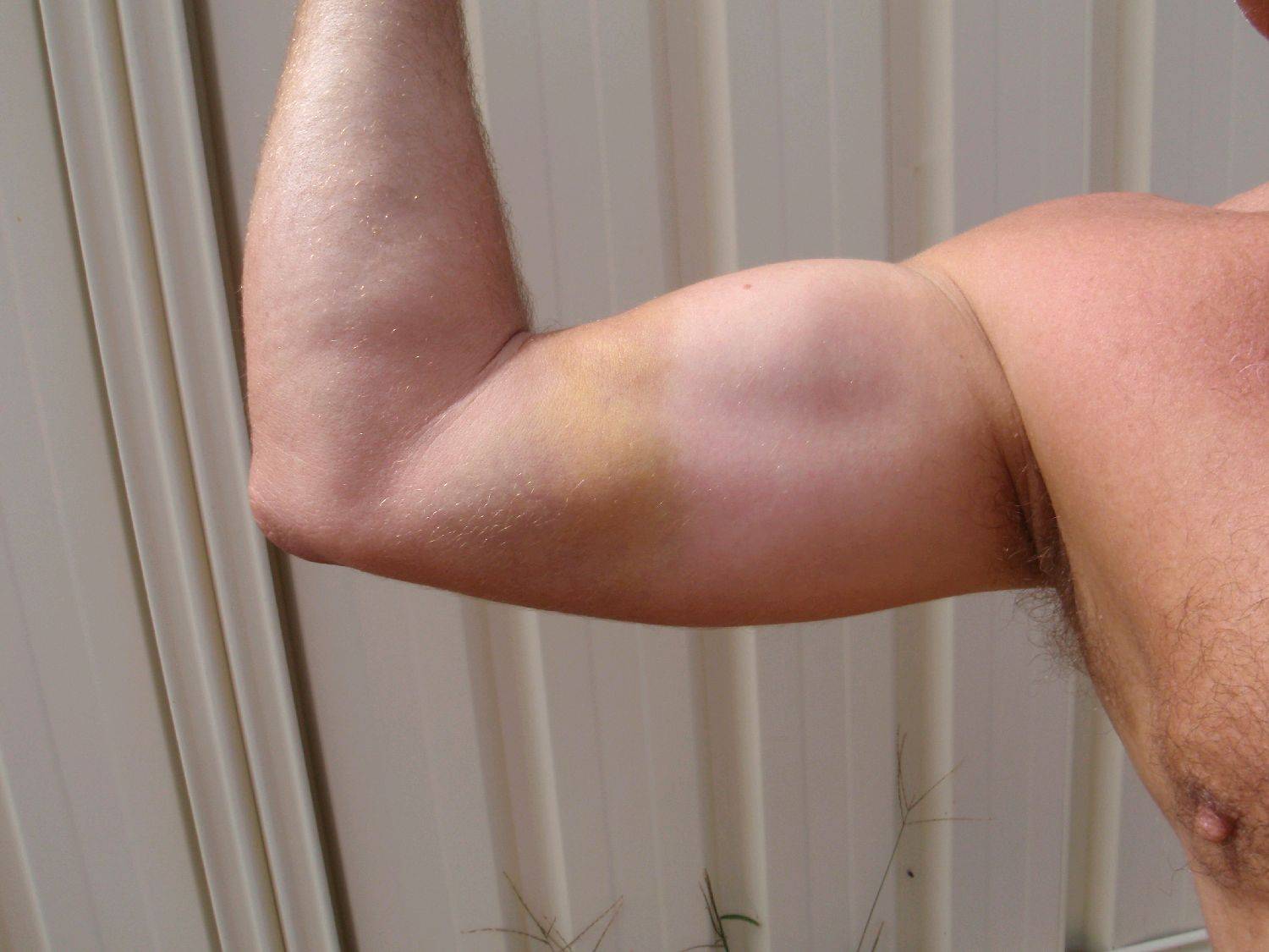 Bruise from wrapped kite lines