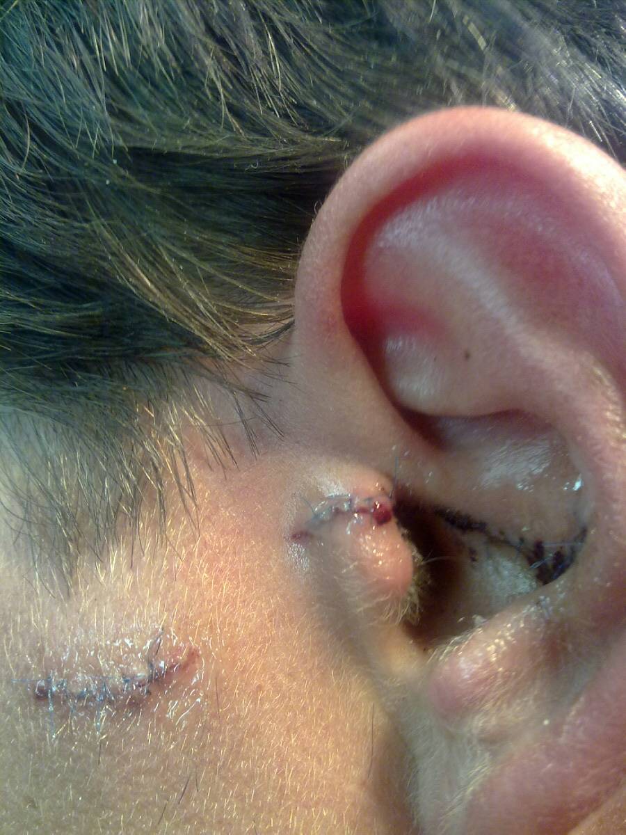 busted ear