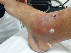 my ankle