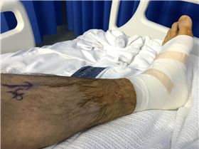 Surgery after breaking my ankle