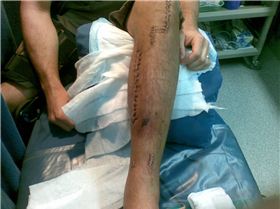 My broken leg after surgery... mmmm im hungry
