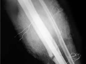 Broken Tibia and Fibula