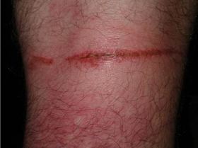 back of knee after getting dragged underwater by kiteline