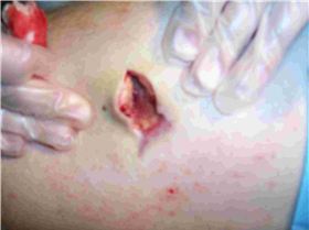 Stingray wound after 5 weeks