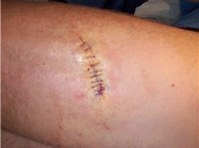 Stingray hole after 7 weeks