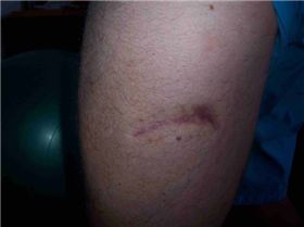 Stingray Scar 11 months later