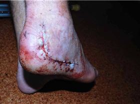 Heel Injury
