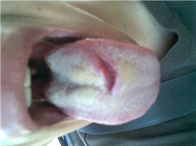 What happens when you stick you tongue out while kiting.1rst Pic when it happend 2nd pic 1week later