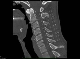 Displaced Spine at the bottom of the lines ( about 2mm)