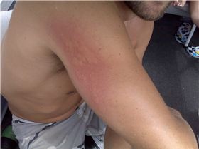 Blue Blubber Jellyfish Sting