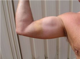 Bruise from wrapped kite lines