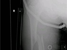 Fractured femure