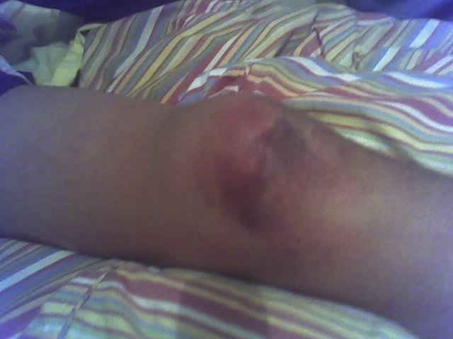 My injured knee