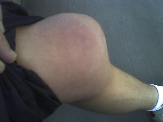 My injured knee