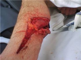 NSW kiter gets injured