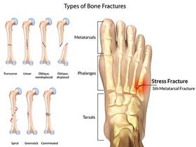 Foot-Fracture-Doctor-NYC