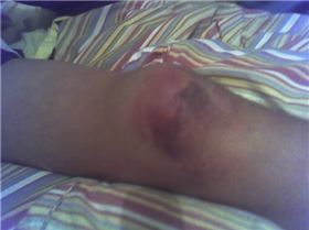 My injured knee