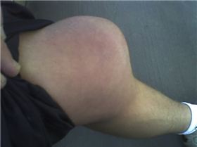 My injured knee