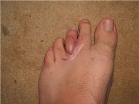 Foot sealant