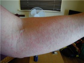 dermatits - sun reaction? itchy as and just about all over my body