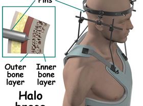 neck fractures treatment