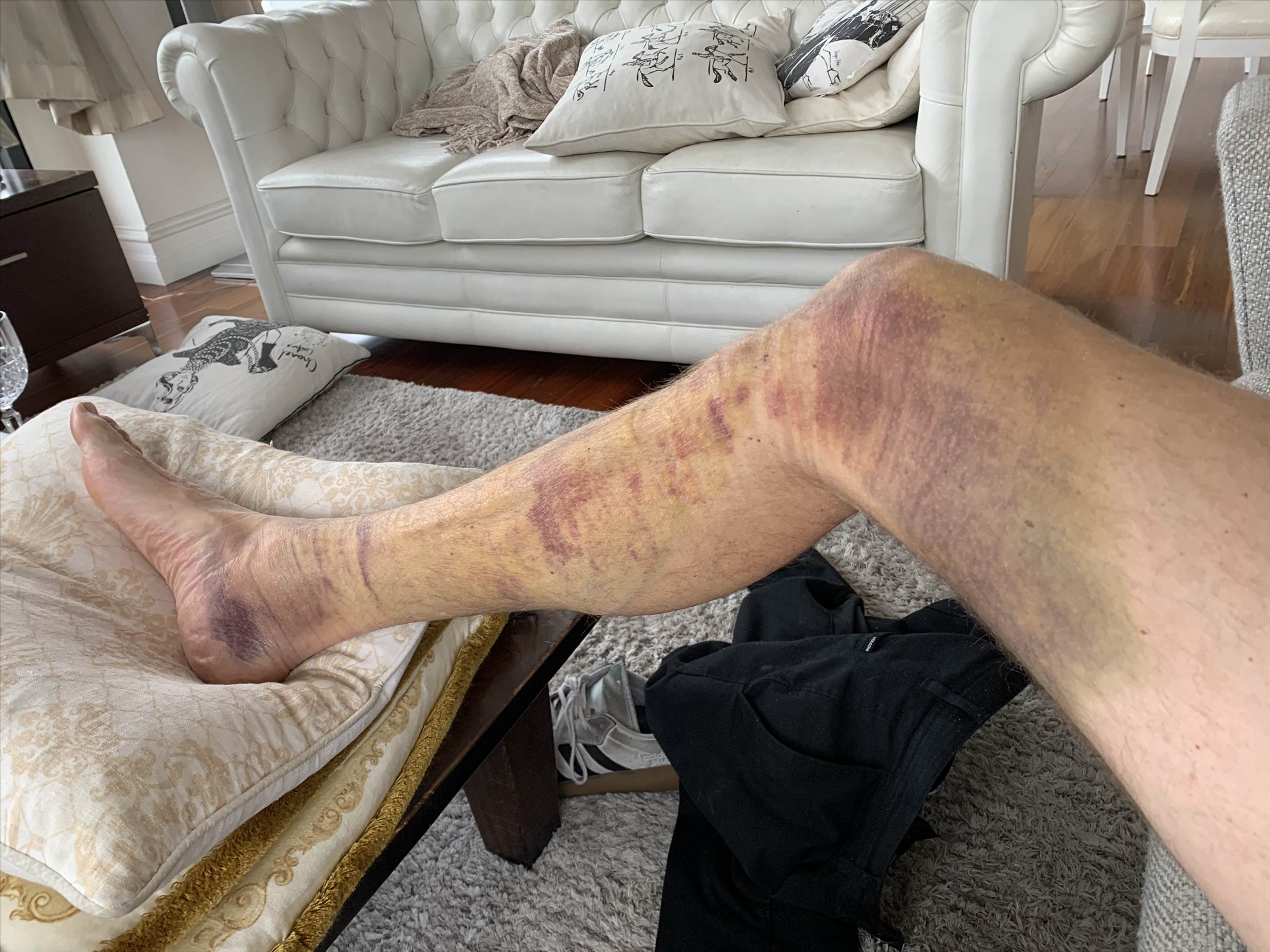 Bruised from jumping off the front