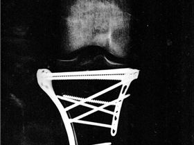 tibial plateau fracture