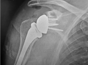 Shoulder replacement