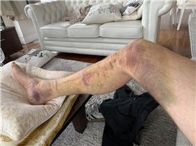 Bruised from jumping off the front