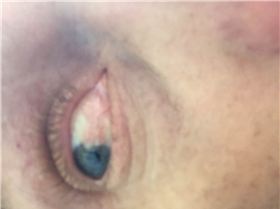 Let my pterygium speak for itself