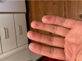 Bruised fingers