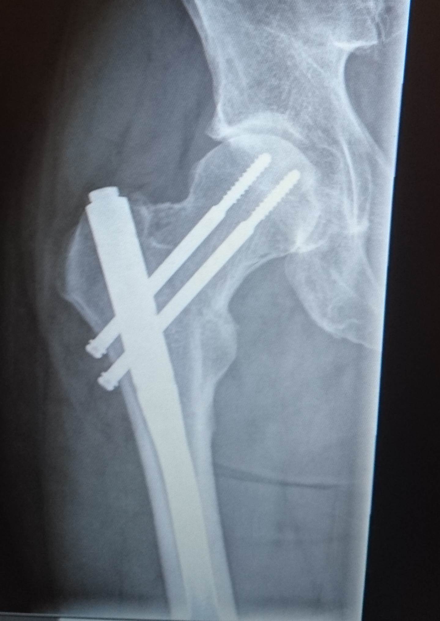 The bionic man, without the bionics