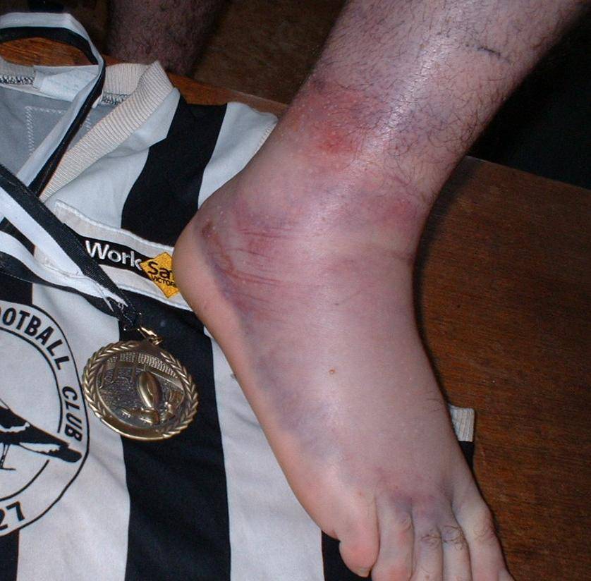 non-w/surfing ankle injury