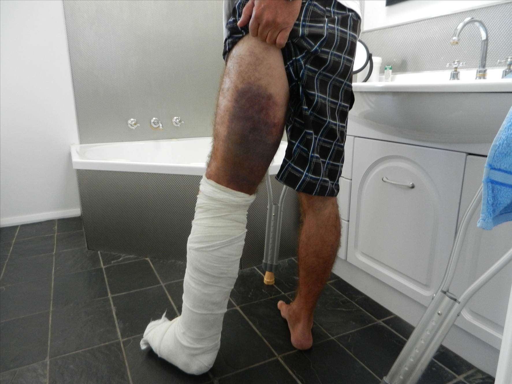 CrackerJack's broken leg