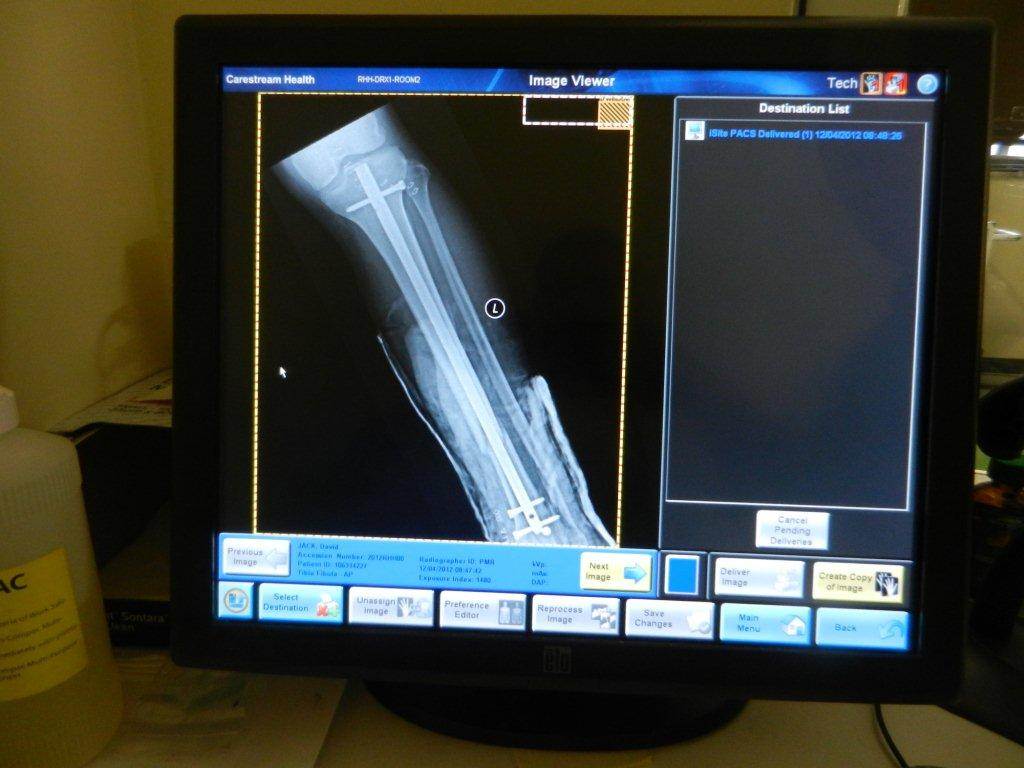 My new leg