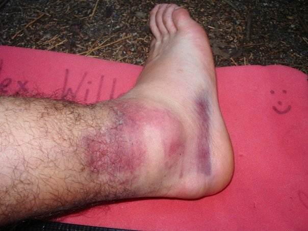 sprainedankle