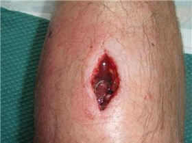 Hole in Leg