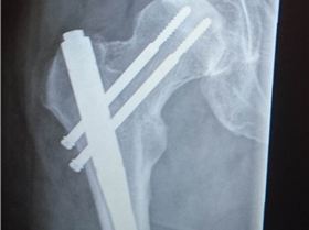 The bionic man, without the bionics