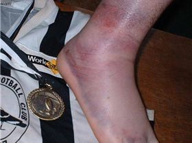 non-w/surfing ankle injury