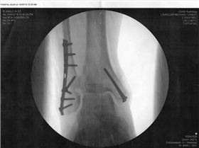 Ankle and screws001