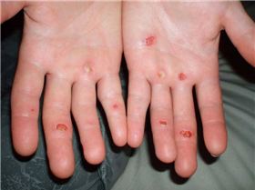 Nananu-i-Ra Blisters